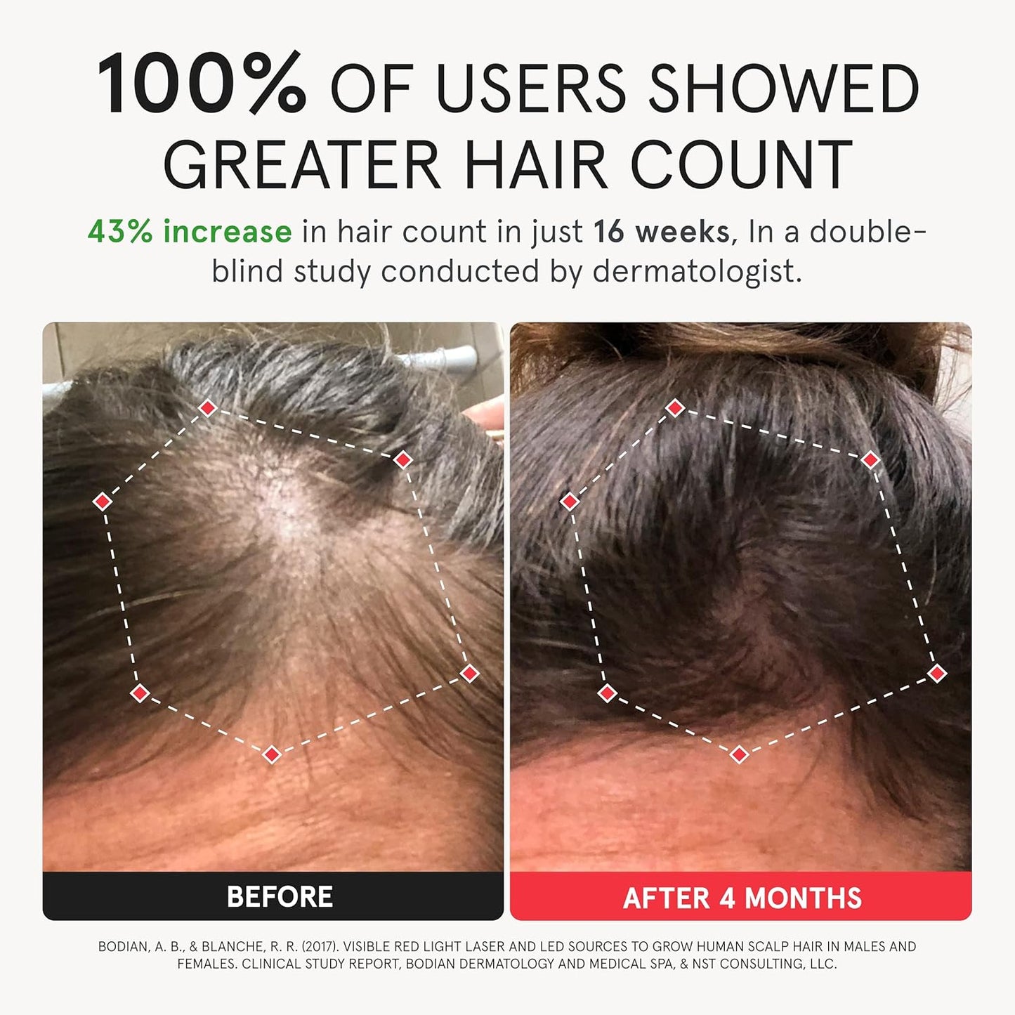 iRestore Elite + Rechargeable Battery Pack - Laser Red Light Therapy for Hair Growth - FDA Cleared Hair Loss, Hair Thinning Treatment for Men & Women - Hair Regrowth Laser Cap - 500 Lasers & LEDs