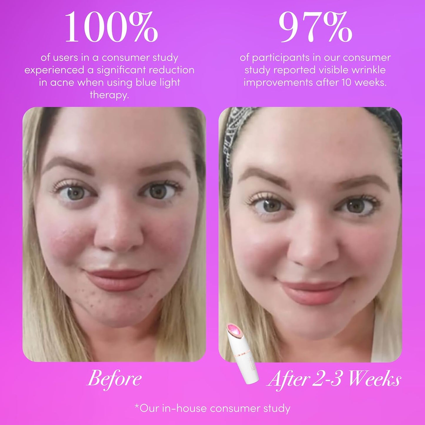 reVive Light Therapy Lux Collection Spot Acne Device for Face, Portable Red & Blue Light Therapy