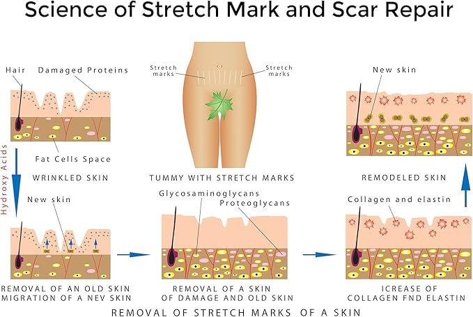 Best Stretch Marks Cream Prevent & Reduce Marks Reduce Pregnancy Stretch Marks Highly Concentrated Cream includes $29 Scar Reducing Guide