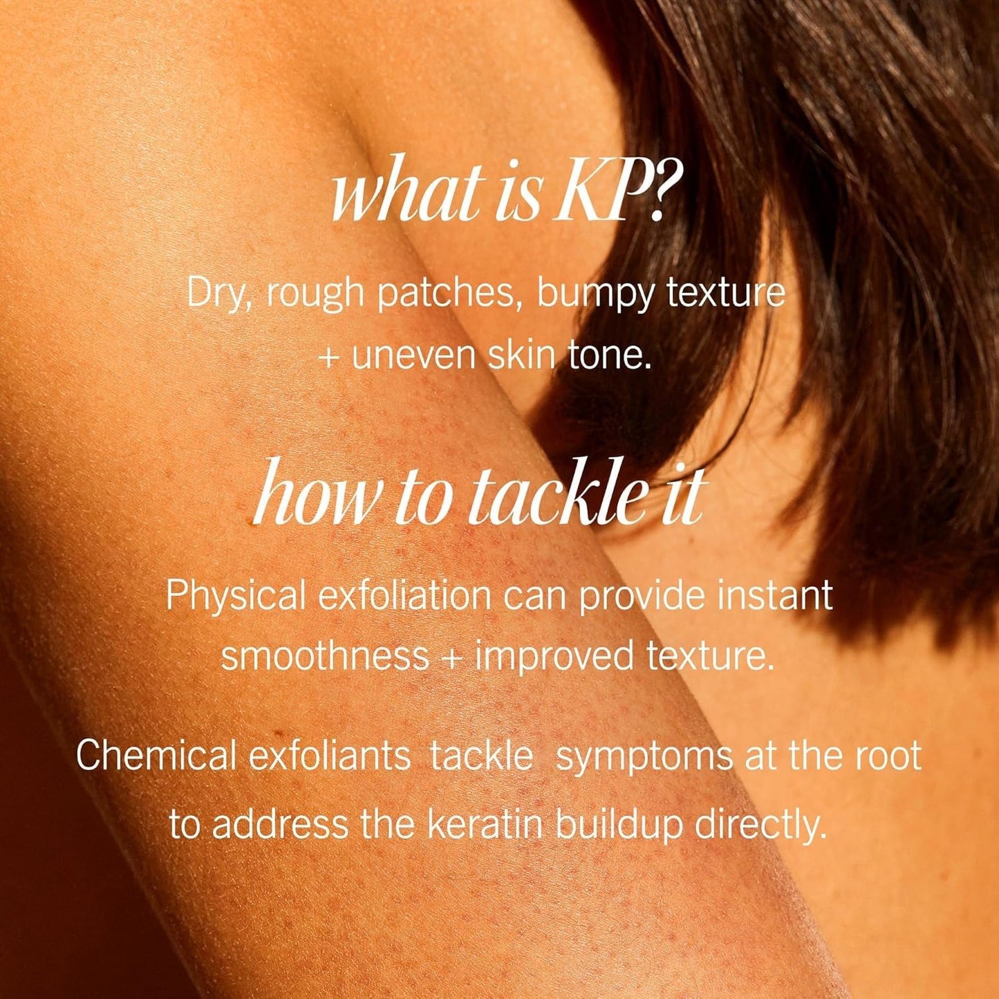 First Aid Beauty - KP Bump Eraser Body Scrub with 10% AHA, Keratosis Pilaris Skin Exfoliator with Glycolic and Lactic acids, Helps Reduce Chicken Skin Bumps, Safe for Sensitive Skin, 2 oz